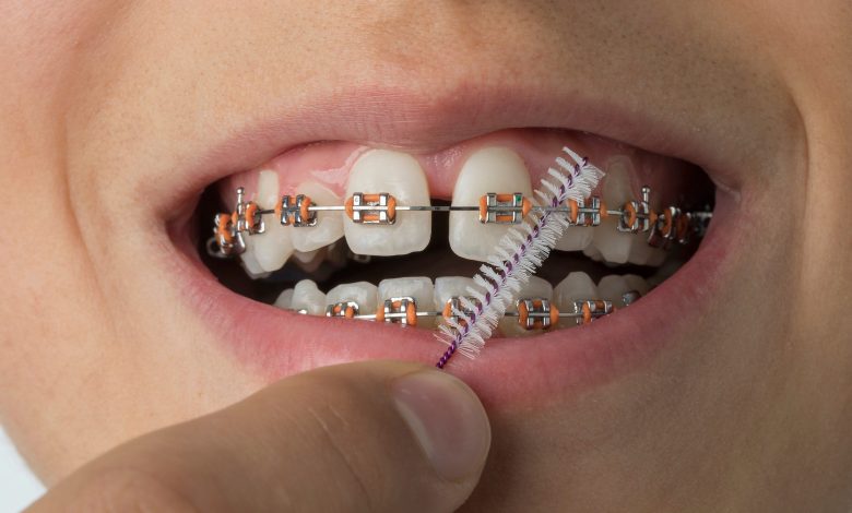 تعرف على أهم أنواع علاجات تقويم الأسنان وكيفية العناية بها