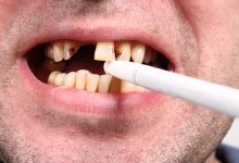 تأثير التدخين على الأسنان: آثاره وكيفية الوقاية والإقلاع