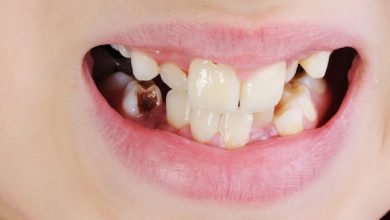 ما هو تسوس الأسنان؟ تعرف على أسبابه وعلاجه