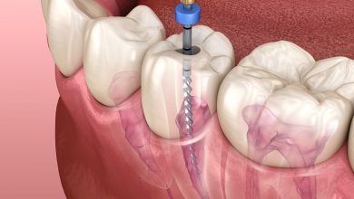 تعرف على كيفية إزالة عصب الأسنان بدون ألم
